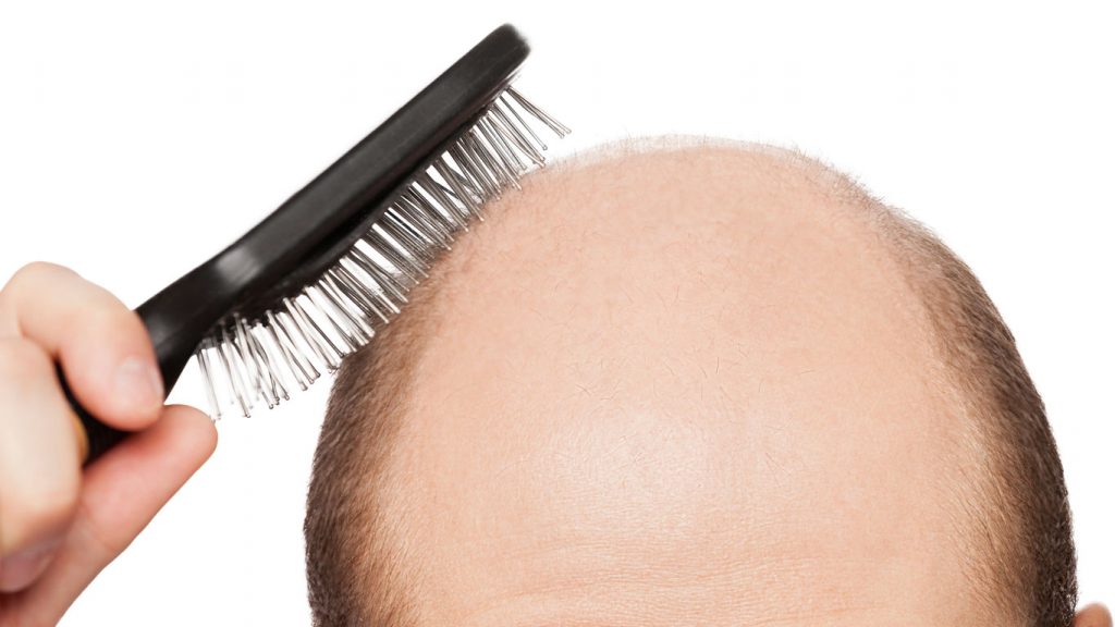 Warum bekommen Männer eine Glatze?