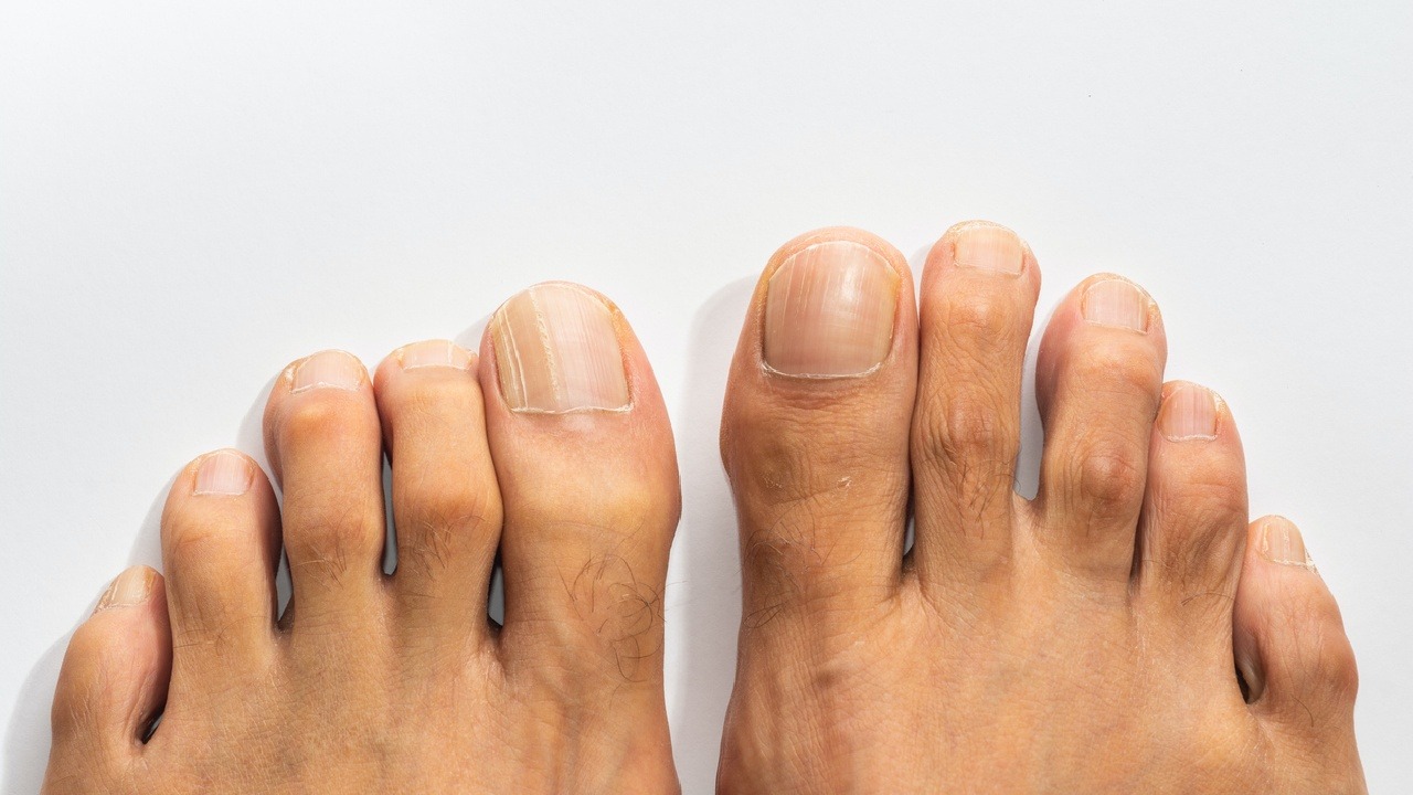 Nagelpilz auf schonende Weise in den Griff bekommen