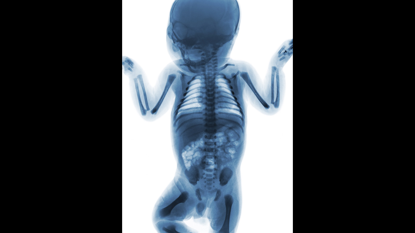 Warum haben Babys mehr Knochen als Erwachsene?