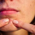 Zystische Akne: Auswirkungen auf die Selbstwahrnehmung und Tipps für mehr Selbstvertrauen