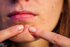 Zystische Akne: Auswirkungen auf die Selbstwahrnehmung und Tipps für mehr Selbstvertrauen